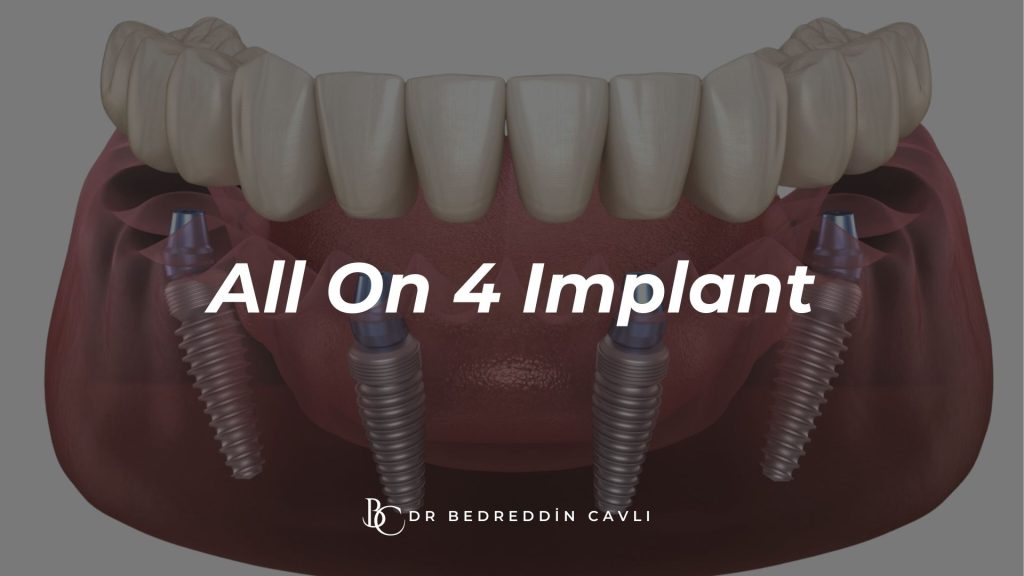 all on 4 implant