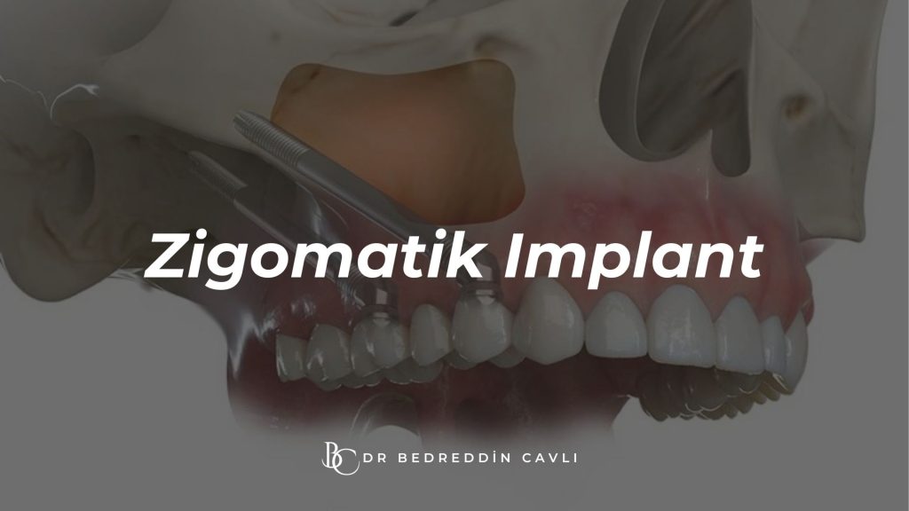 zigomatik implant