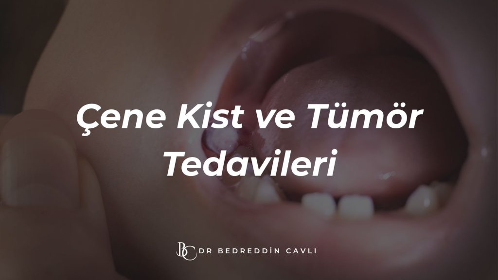 Çene Kistleri ve Tümörleri